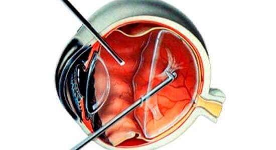 Cirurgia Vitrectomia Anterior