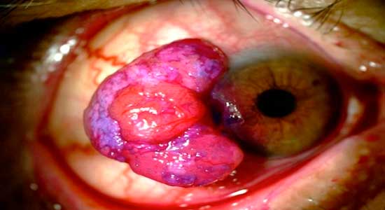 Cirurgia de Tumor Conjuntivo