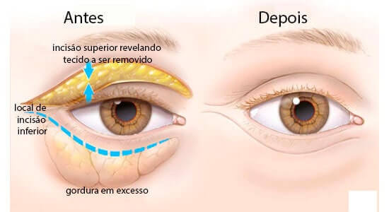 Cirurgia de Blefaroplastia