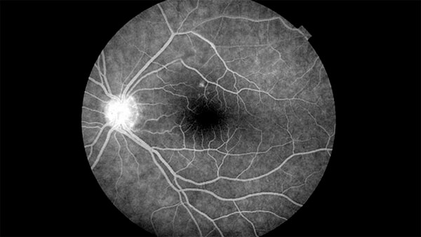 Retinografia Fluorescente